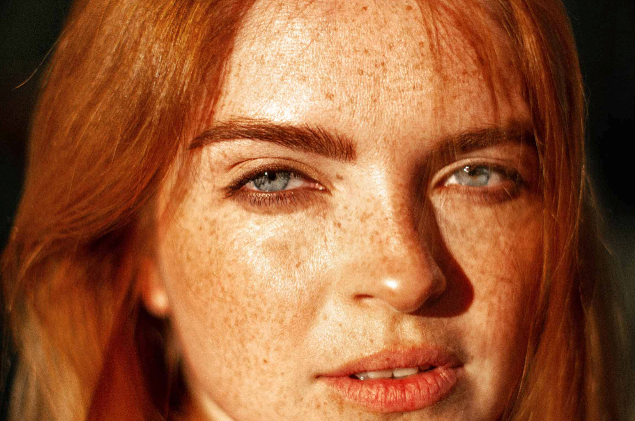 What causes pigmentation, and why winter is the time to treat it